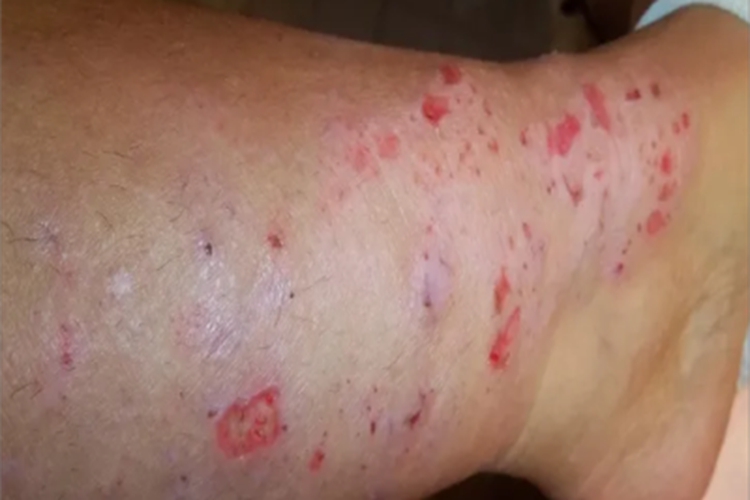 艾滋病急性感染期糜烂图