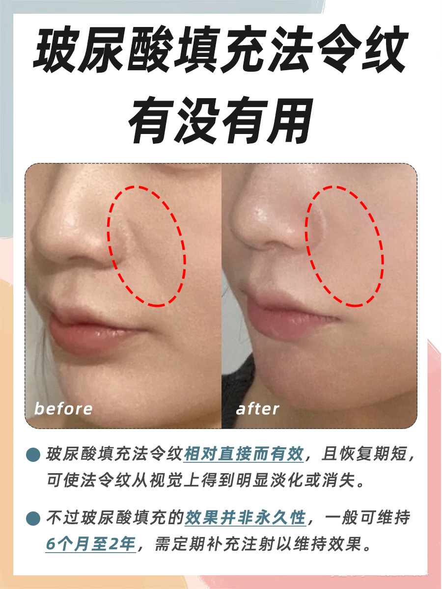 医生提醒求美者必看:玻尿酸填充法令纹有用吗