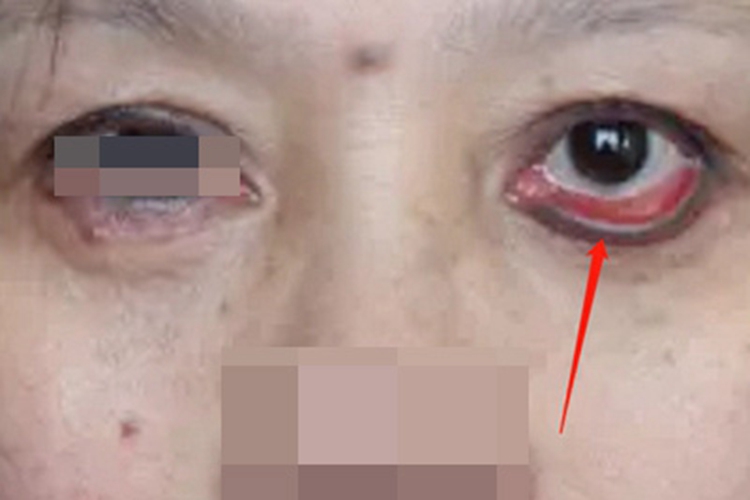 睑外翻眼睑变形外翻图 睑外翻眼睑变形外翻图