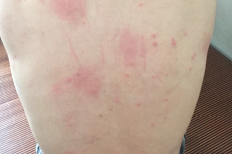 跳蚤叮咬红点图