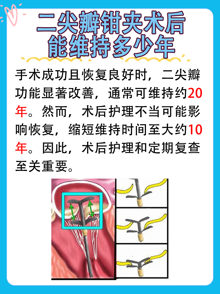 二尖瓣钳夹术后，能维持多久？