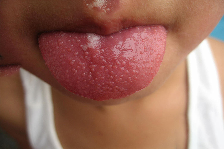儿童猩红热发病早期杨梅舌图