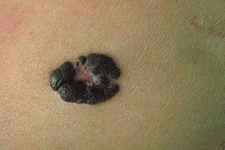 艾滋病皮肤黑色素瘤图