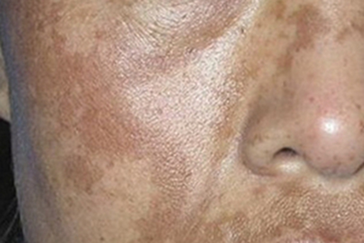 黄褐斑脸上有棕褐色斑图 黄褐斑脸上有棕褐色斑图