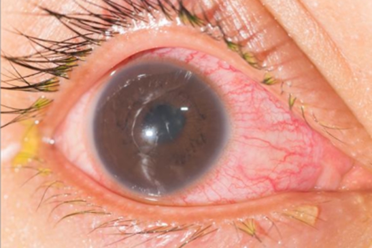 红眼病眼球有红血丝伴渗液图