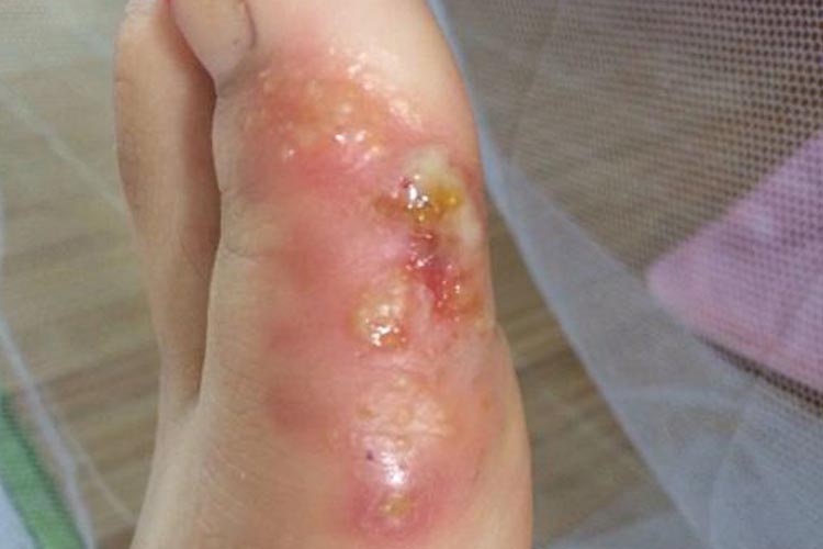 水疱破溃形成糜烂面图