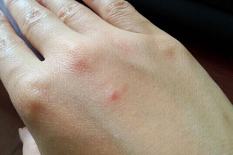 为什么被蚊子咬了起红点