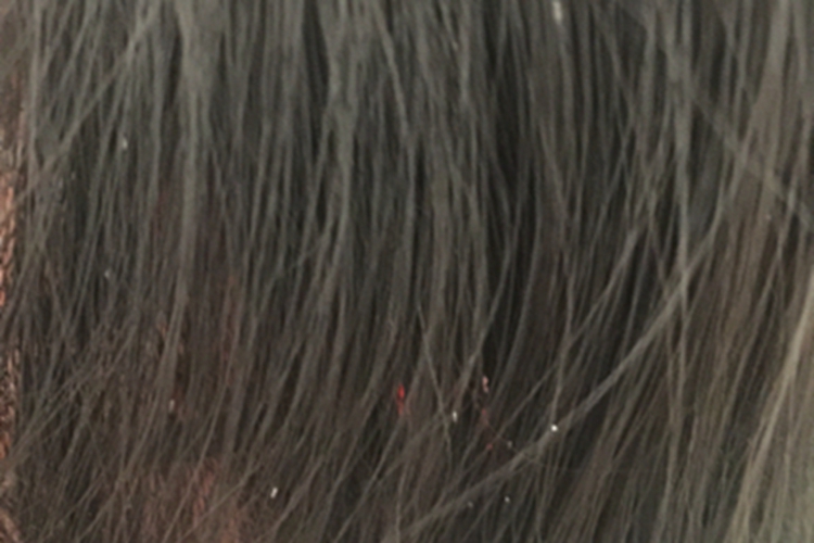 毛发管型症状图