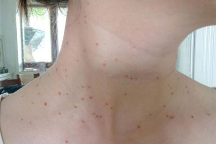 脖子和胸口丝状疣图 脖子和胸口丝状疣图