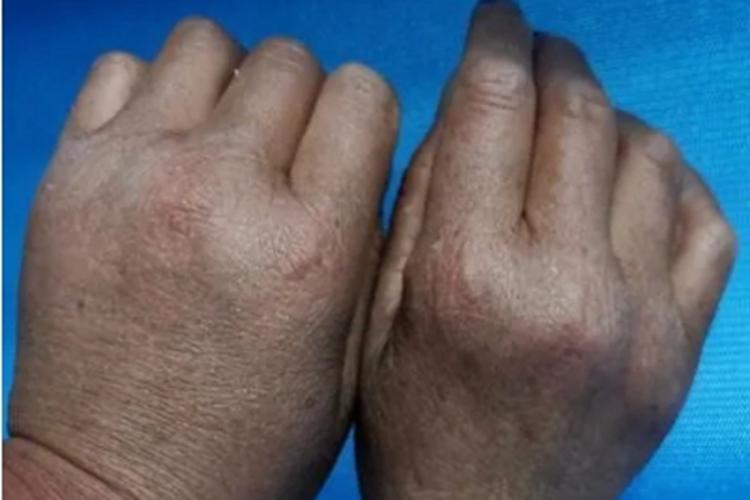 植物-日光性皮炎手背皮肤粗糙图