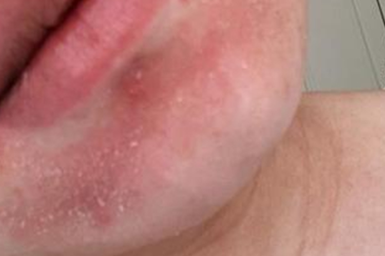 下巴体癣湿疹样图 下巴体癣湿疹样图