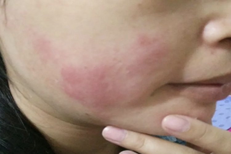 海鲜过敏面部症状图 海鲜过敏面部症状图