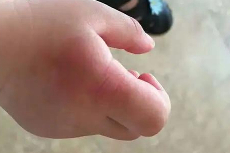 烫伤恢复过程中色素沉着图