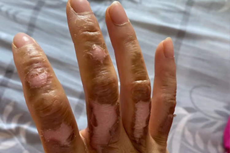 二度烫伤手指破皮发红图 二度烫伤手指破皮发红图