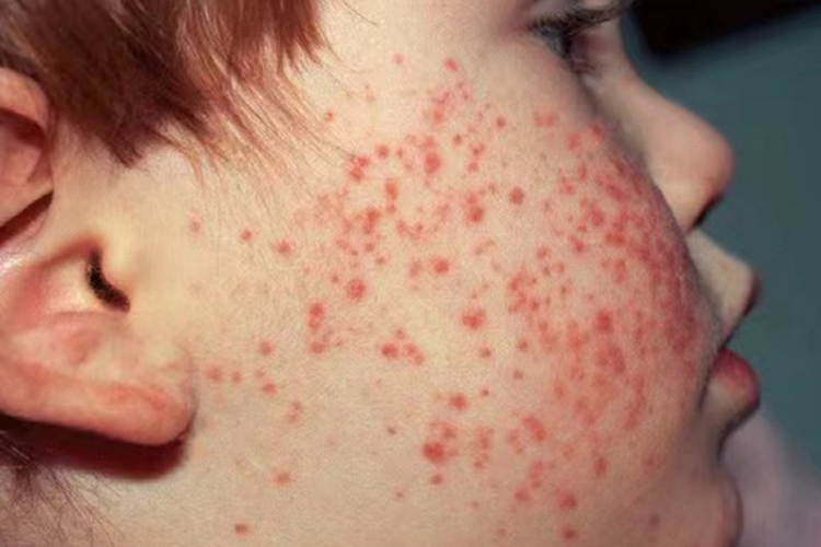 幼儿急疹面部红色斑丘疹图 幼儿急疹面部红色斑丘疹图