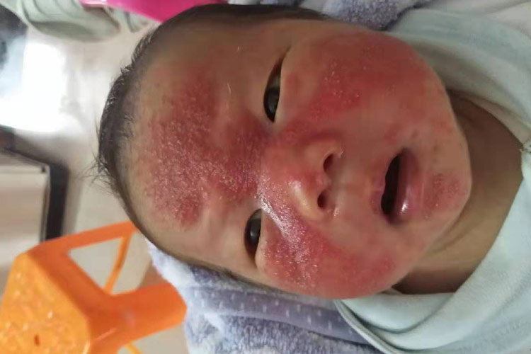 婴儿面部脂溢性皮炎图 婴儿面部脂溢性皮炎图