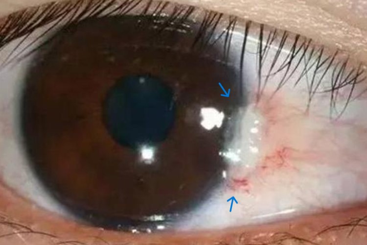 翼状胬肉眼球疙瘩图