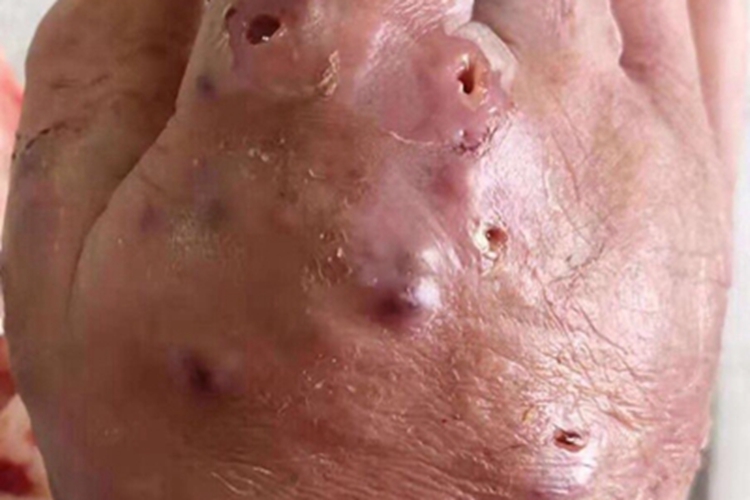 瘰疬性皮肤结核手背症状图