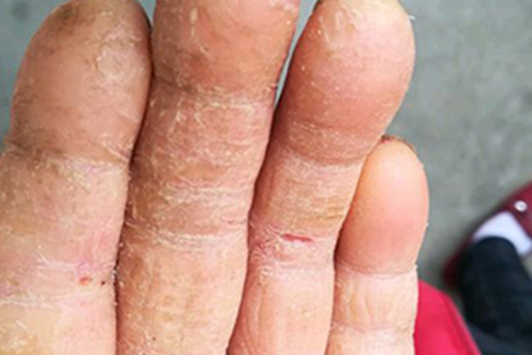 皲裂性湿疹手指粗糙有裂口图 皲裂性湿疹手指粗糙有裂口图