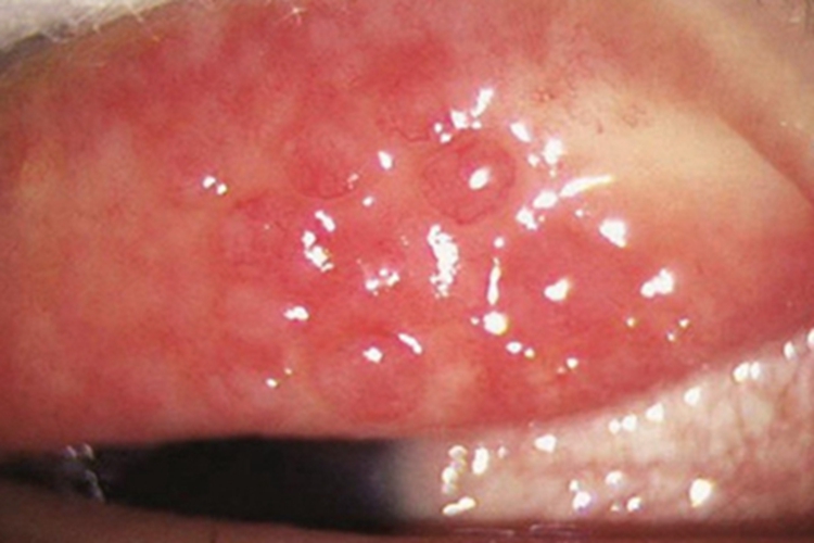 常年性过敏性结膜炎疙瘩图 常年性过敏性结膜炎疙瘩图
