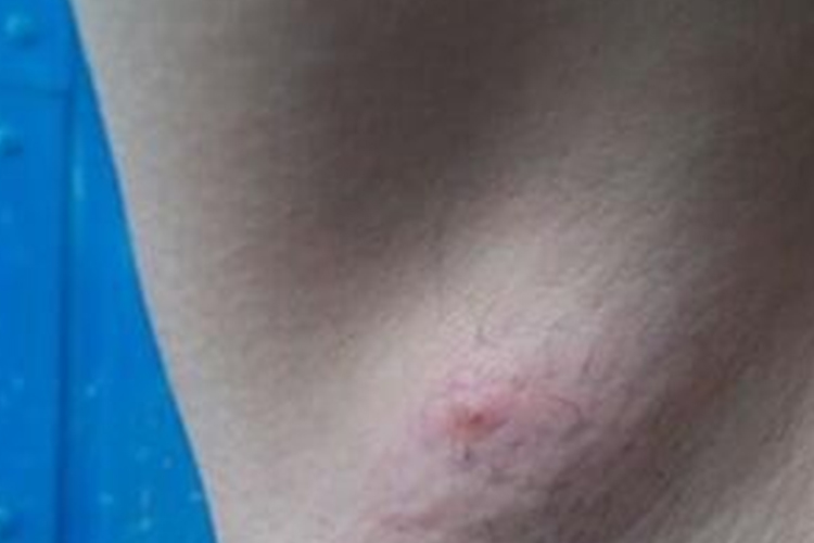 艾滋病腋窝淋巴结肿大图