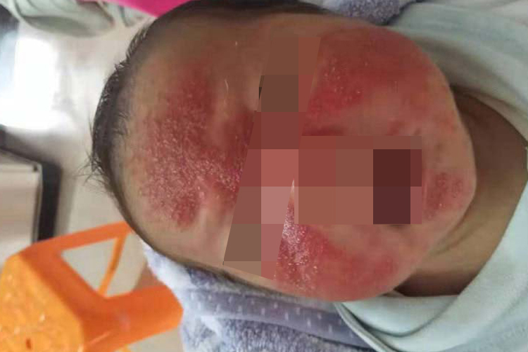 儿童脂溢性皮炎图