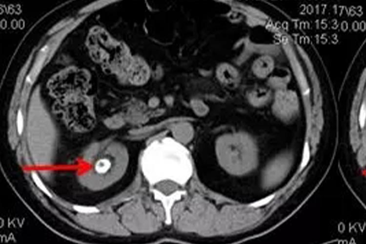 肾结石的CT检查图