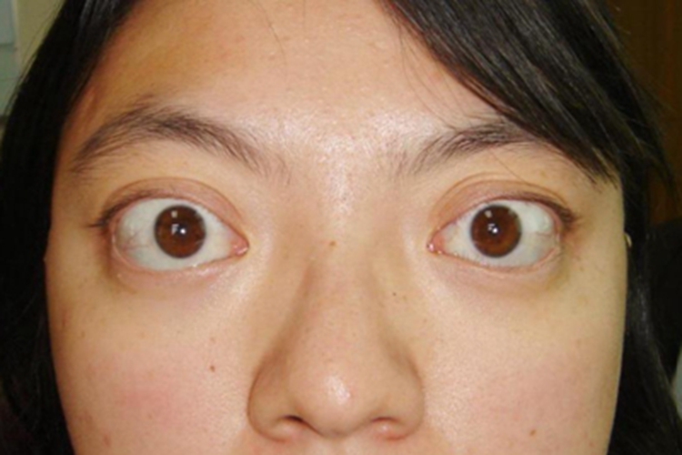 甲状腺相关眼病眼部畸形图 甲状腺相关眼病眼部畸形图