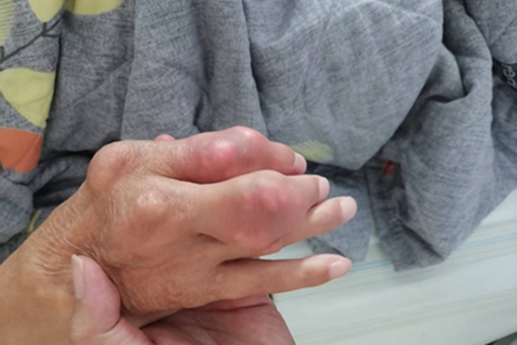 痛风手部症状图 痛风手部症状图