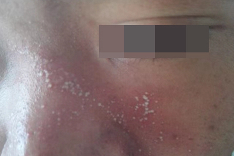 隐翅虫皮炎面部症状图