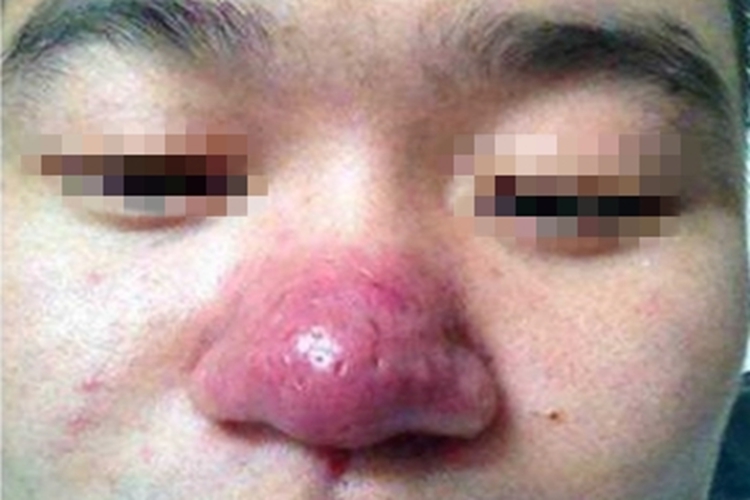 鼻赘型酒糟鼻红斑图