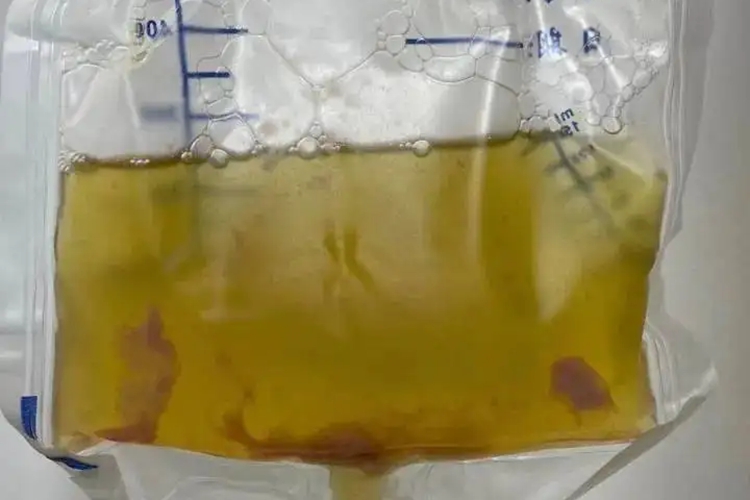 胸腔积液絮状物图