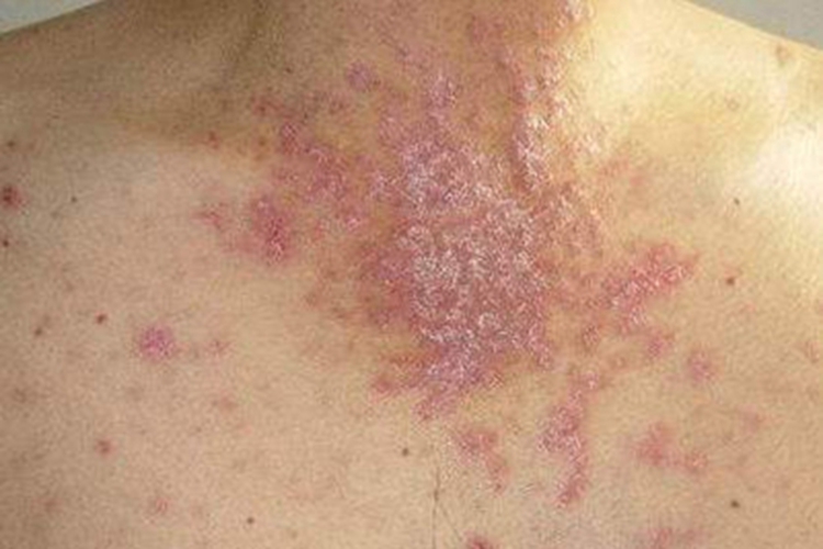 扁平苔藓胸部症状图 扁平苔藓胸部症状图