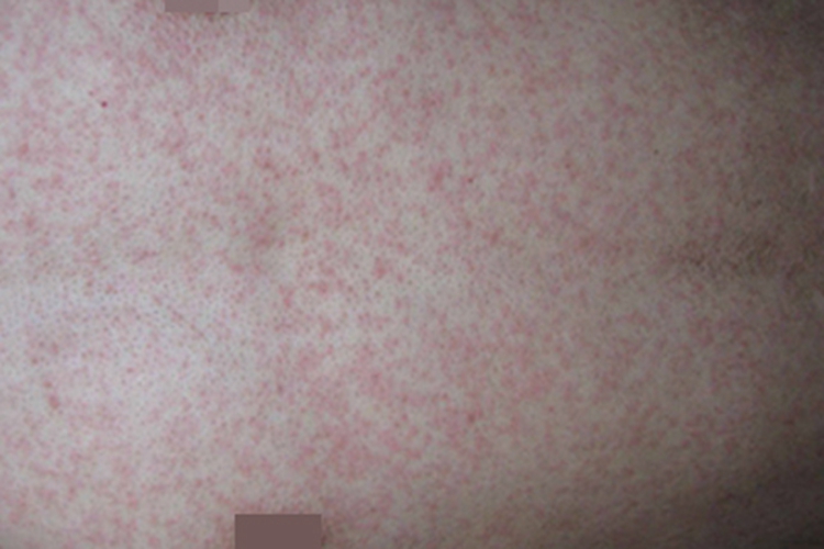 典型麻疹出疹期胸部红点图