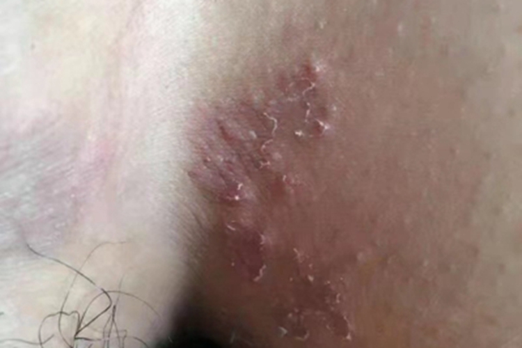 股癣大腿根有皮疹起鳞屑图 股癣大腿根有皮疹起鳞屑图