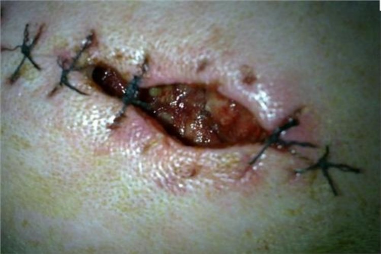 糖尿病患者伤口感染图 糖尿病患者伤口感染图