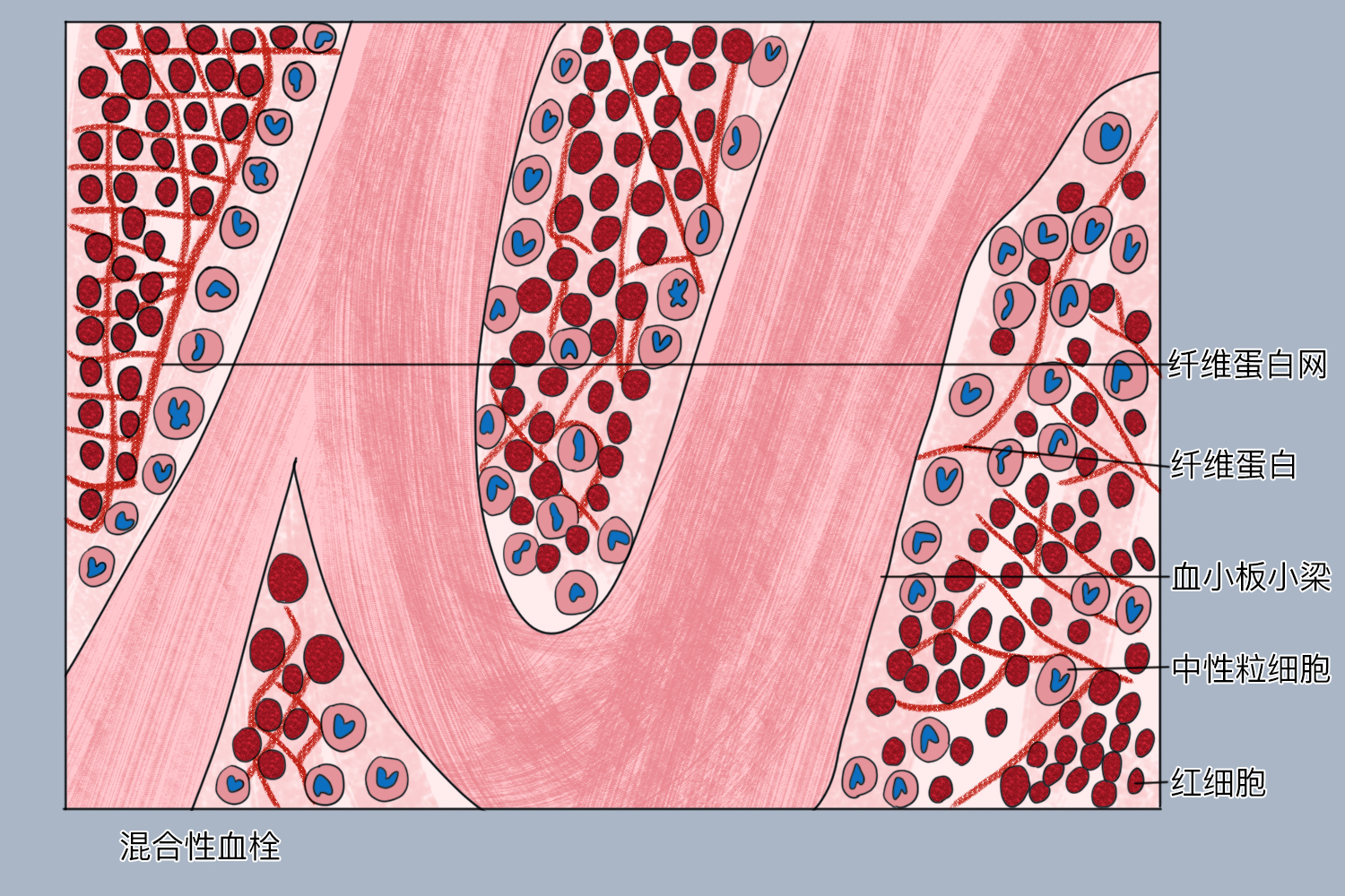 混合血栓手绘图