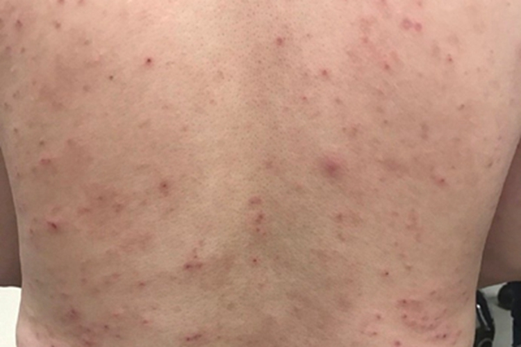 慢性接触性皮炎背部结痂图 慢性接触性皮炎背部结痂图