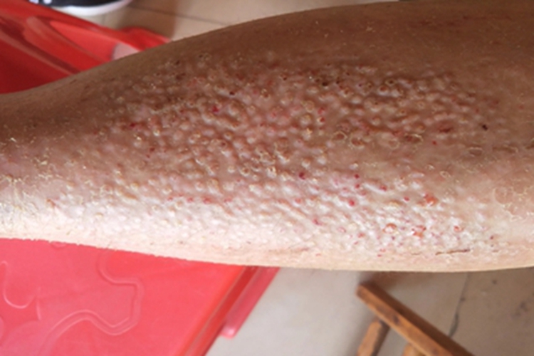 斑状淀粉样变丘疹图 斑状淀粉样变丘疹图