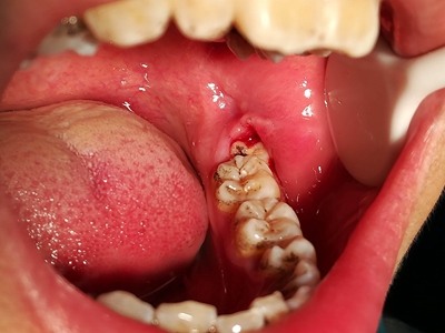 智齿冠周炎智齿周围牙龈肿胀出血图