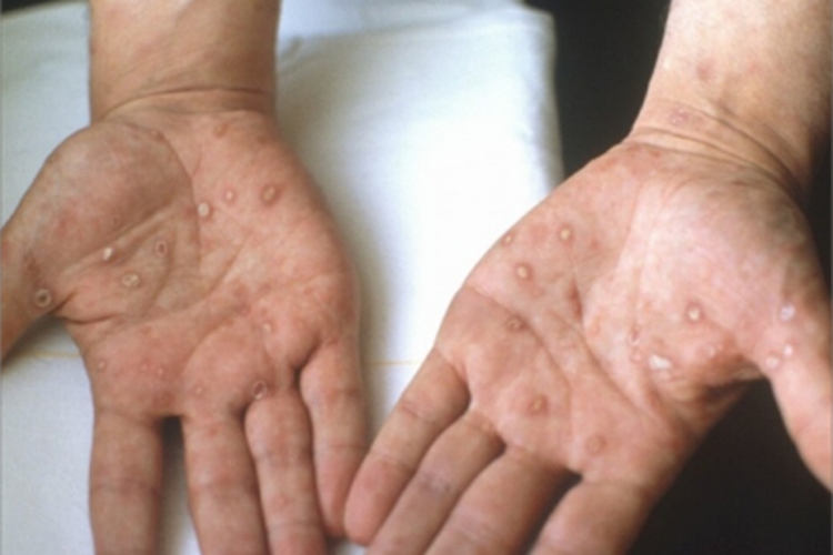女性梅毒手部脱皮图