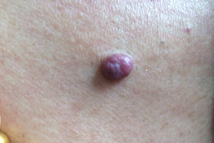 樱桃状血管瘤图