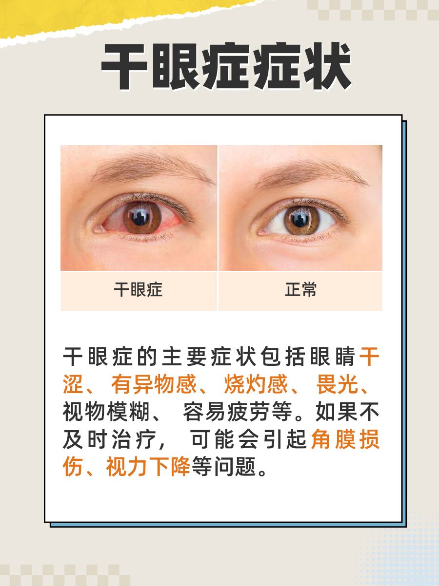 出现这些症状，小心干眼症！