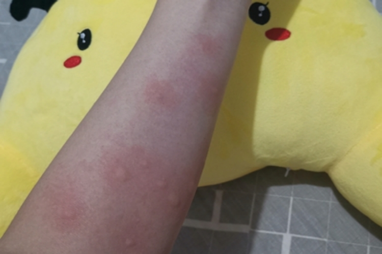 血吸虫病胳膊上长疙瘩图 血吸虫病胳膊上长疙瘩图