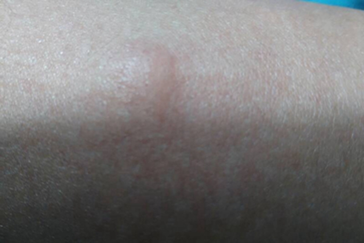 透明细胞汗腺瘤小腿症状图