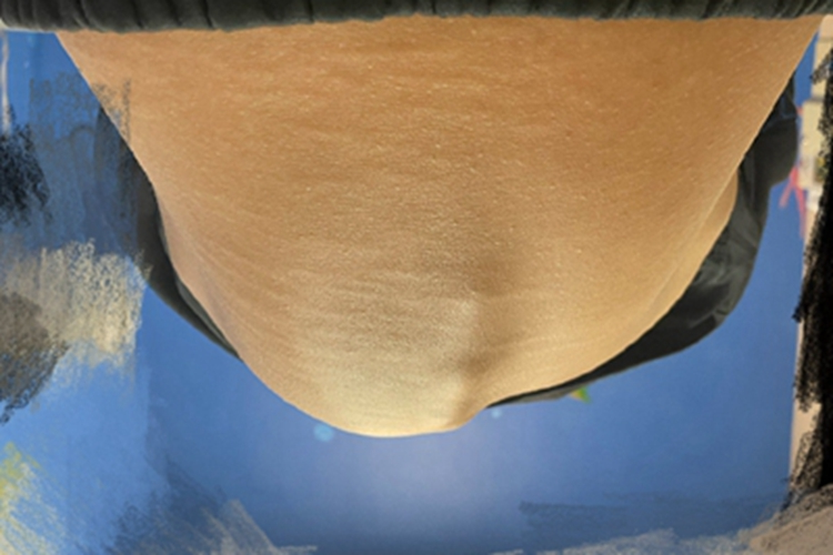 青少年特发性脊柱侧弯背部畸形图