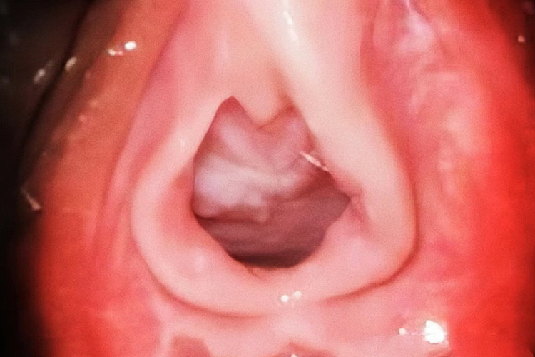 没有破裂的处女膜图