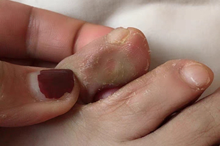 寻常疣皮肤颜色加深图