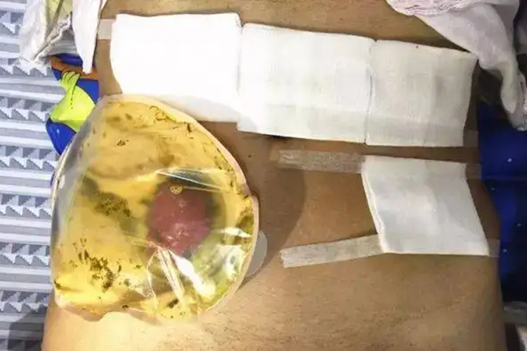 人工造瘘口挂造口袋图