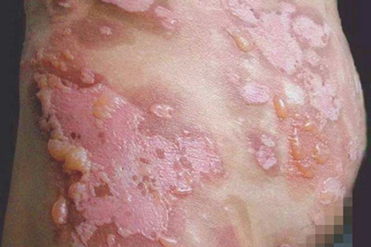 光接触性皮炎腹部水疱图